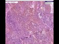 Histopathology Liver, lymph node --Hemochromatosis-hemosider