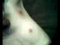 HUGE ZIT