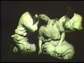 An early case of MDD