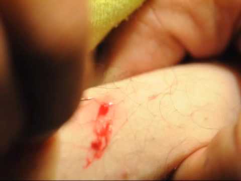 Ingrown Epic Zit Pop