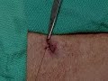 Simple suturing technique - free flv video @ vwatch.tv