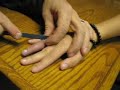 traumatic finger