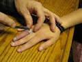 traumatic finger