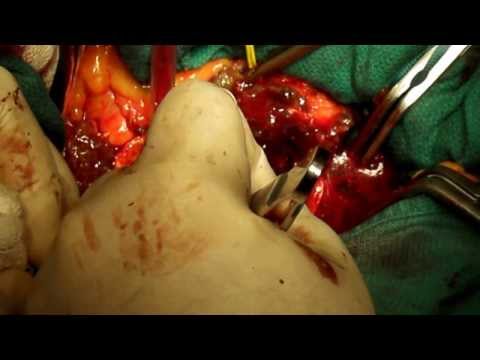 how to repair abdominal aortic aneurysm