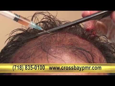 how to sleep after hair transplant