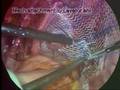 videos de Laparoscopic Prolapse operaton.wmv