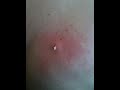 Callum's Pus Buddy