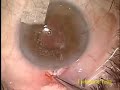 Trabeculectomy Mitomycin C Right Eye