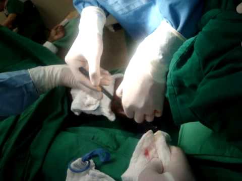 Amputação transtibial Equipe de Angiologia e Cirurgia Vascular HSM SP