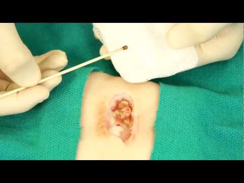 how to treat umbilical granuloma with salt