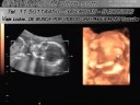 GRAVIMAGEM 46 (ULTRA-SOM GRAVIDES 3D 4D COM 19 SEMANAS) GRAVIMAGEM 46 (ULTRA-SOM GRAVIDES 3D 4D COM 19 SEMANAS)