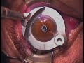 cirug�a laser ocular Jordi