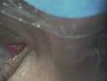cirujia laser ocular Jordi