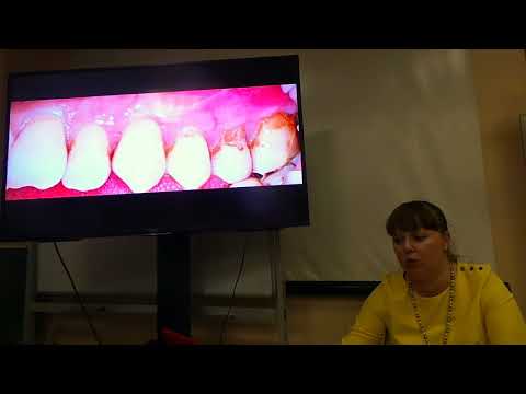 Хирургическое лечение рецессий десны в области зубов и имплантатов. Часть 23