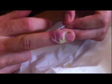 how to relieve fingernail pain