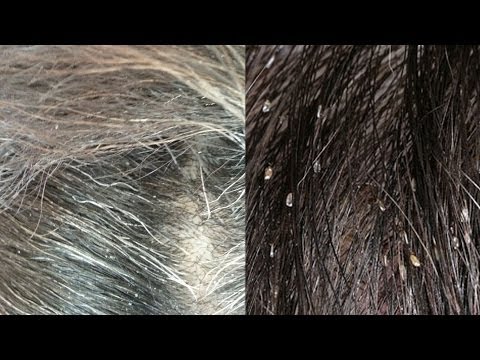 how to know if u have lice
