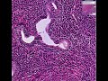 Histopathology Uterus--Endometrial adenocarcinoma