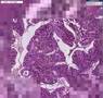 Histopathology Uterus--Endometrial adenocarcinoma