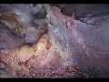 Laparoscopic Right Adrenalectomy and Partial Nephrectomy