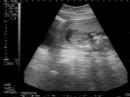 Ecografia Bebe Iriarte Ampuero Ecografia Bebe Iriarte Ampuero