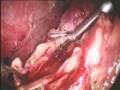videos de LOTUS Shears - Gall Bladder Adhesions
