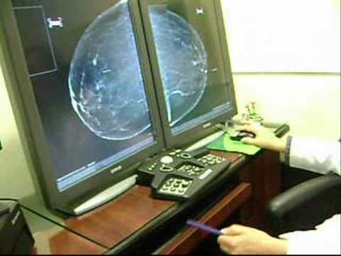 VIDEO: tecnología digital permite mejor detección del cáncer de mama en Lima