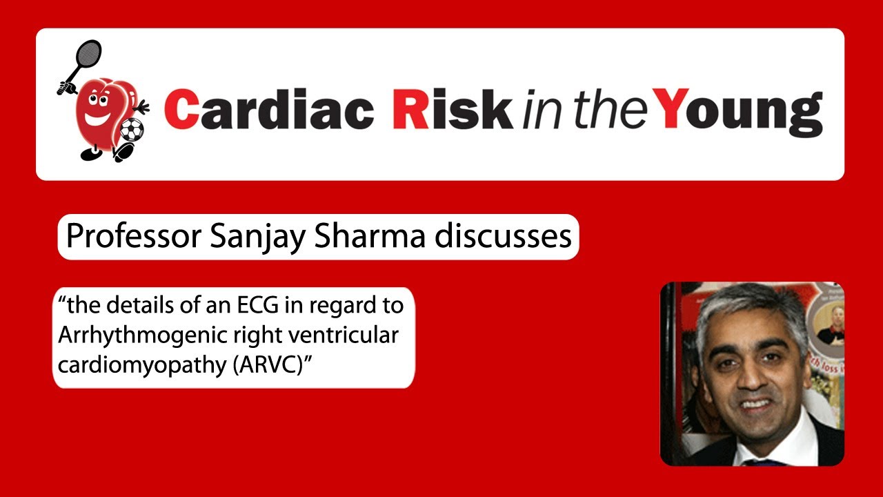 ECG 7: Arrhythmogenic right ventricular cardiomyopathy (ARVC)