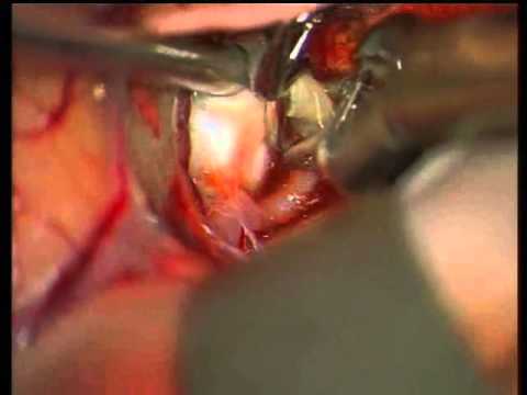 Previously Coiled Aneurysms Microsurgery - Experience on group of 81 patients - Video 5