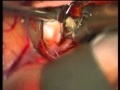 Previously Coiled Aneurysms Microsurgery - Experience on group of 81 patients - Video 5