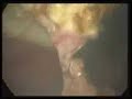 Laparoscopic Myomectomy