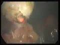 Laparoscopic Myomectomy