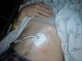 Consequences of Anorexia/Bulimia