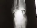 Radiografia Fractura Trimaleolar (SSDF)