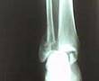 Radiografia Fractura Trimaleolar (SSDF)