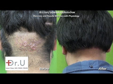 how to treat akn