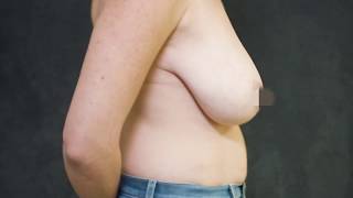 Breast Lift Origami and Reduction, after Twenty-Two Years