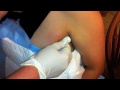 Gross, oozing abscess gets drained!