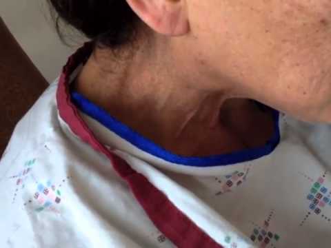 how to assess jugular vein distention