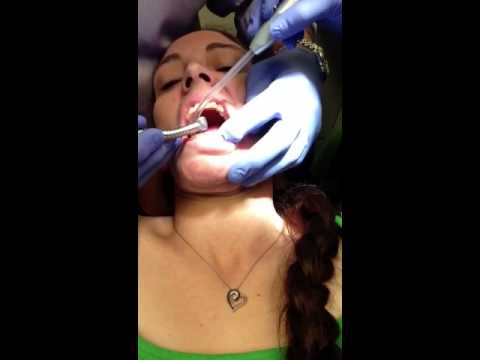 how to dissolve orthodontic cement