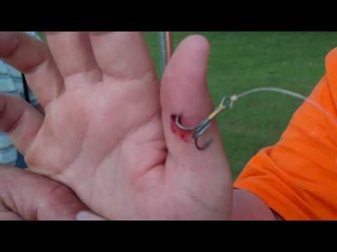 How To Remove A Treble Hook Imbeded In A 13yr Olds Thumb
