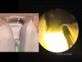 Prostate Vaporisation - Green Light Laser Technique Prostate Vaporisation - Green Light Laser Technique