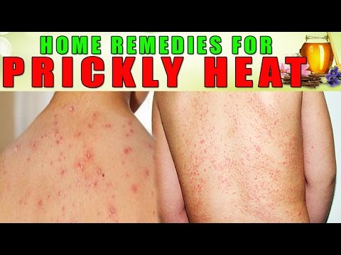 how to cure prickly heat