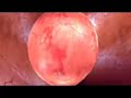 Cell Adhesion Molecule Inhibition