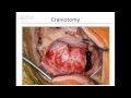 Retrosigmoid craniotomy for cerebellopontine angle/petroclival epidermoid cyst