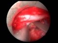 L4-L5 Disc Removal Using Endoscopy