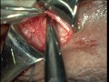 Dermoid cyst Eyelid Soosan Jacob