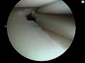 Arthroscopic Partial Meniscectomy