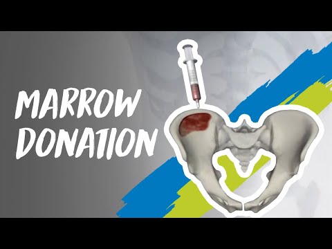 how to give bone marrow transplant
