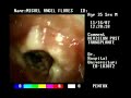 bronchoscopy test bronchoscopy test