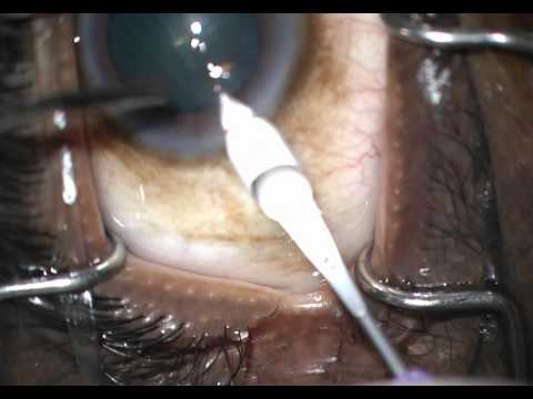 fellow case 4 trabectome phaco part 2 good opening of Schlemm's canal then soft lens stop and chop